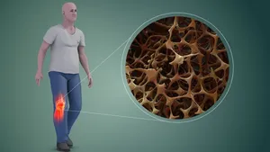 نقش آلودگی هوا در افزایش ریسک ابتلا به پوکی استخوان