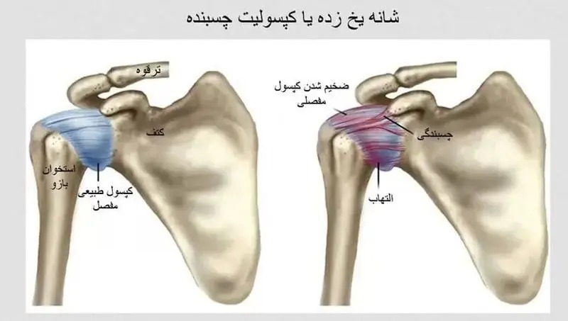 شانه یخ‌زده