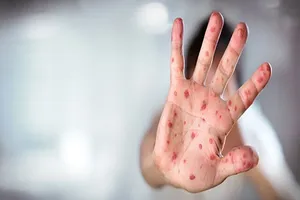 تایید رسمی حذف سرخک و سرخجه در ایران تا سال ۲۰۲۳
