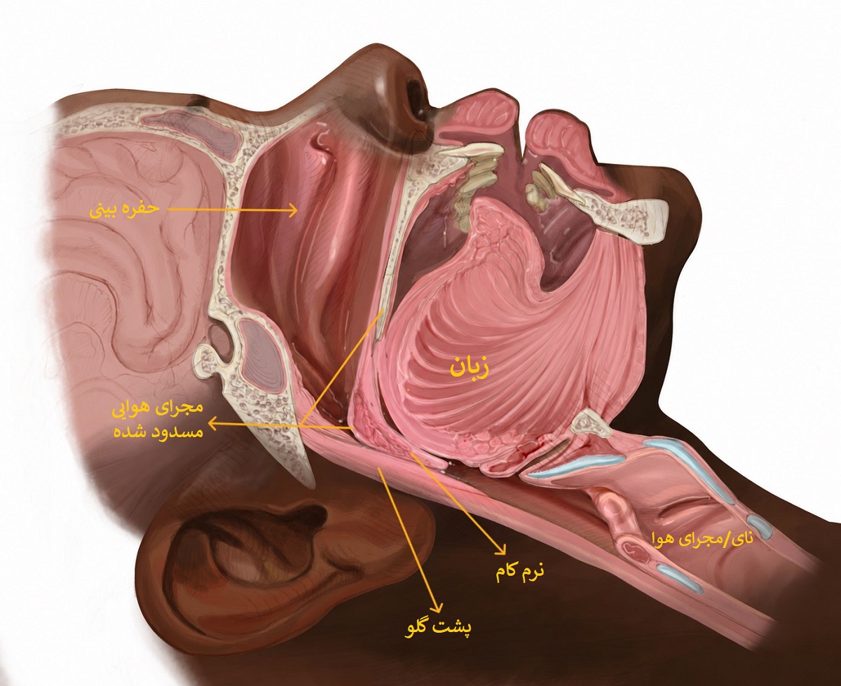 اینفوگرافیک مسدود شدن مسیر تنفسی به واسطه آپنه خواب