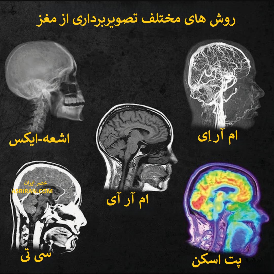 نام انواع روش هایی تصویربرداری از مغز