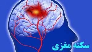 سبقت مردان از زنان در سکته مغزی