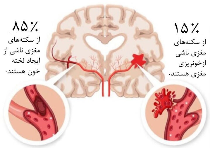 لخته خون در سکته مغزی