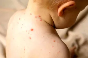 هشدار یک متخصص درباره آمار فاجعه‌بار سرخک و افزایش نهضت ضد واکسن در کشور