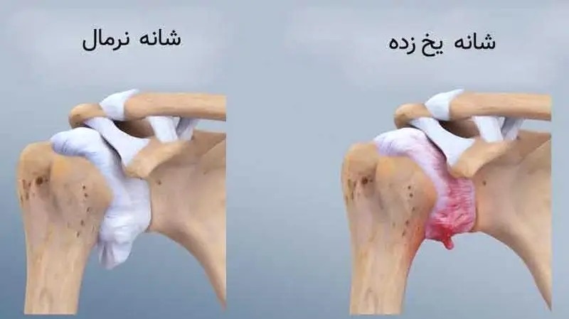 شانه یخ‌زده
