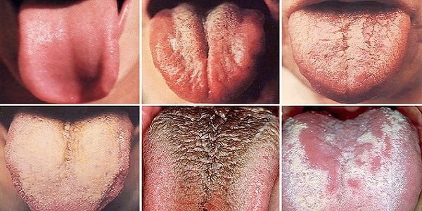 رنگ زبان چه چیزهایی درباره سلامت ما می گوید؟