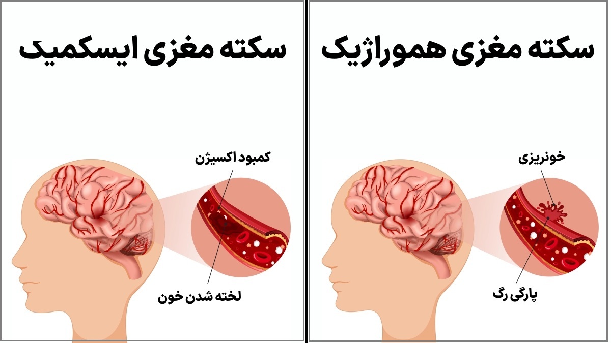 انواع سکته مغزی