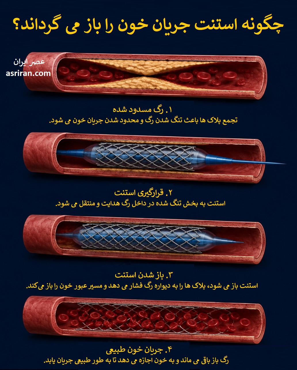 اینفوگرافیک چگونه استنت جریان خون را بازمی‌گرداند